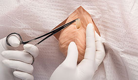 s230-200-No-scalpel-vasectomy