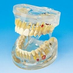 Tooth Disease