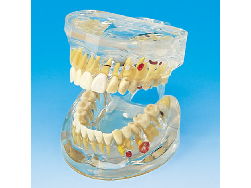 Transparentn model onemocnn zub
