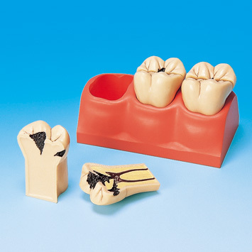4 zvten model zubnch kaz