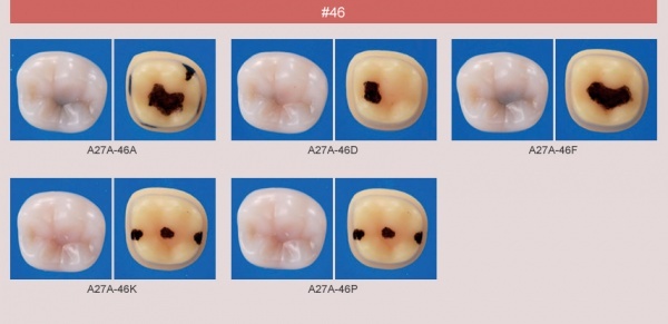 Model zubu se zubnm kazem (zub . 46)