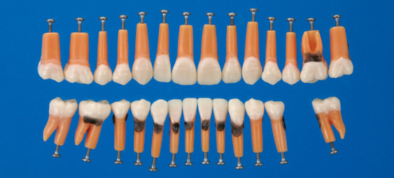 Model zubu s vtvenm a zubnm kamenem (sada 27 zub)