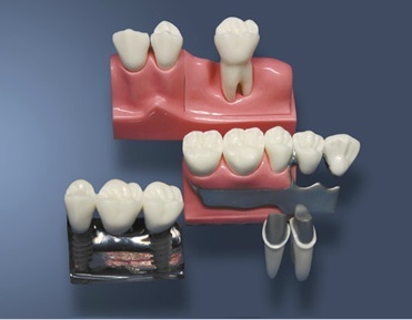 MDO-59 - Rekonstrukce odnmateln sten zubn protzy a implantt
