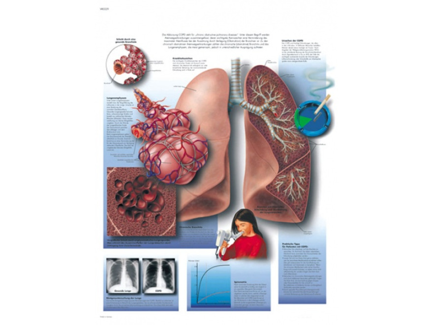 VR1329L - Chronick onemocnn pulmonln obstrukce