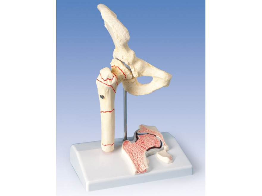 A88 - Stehenn zlomenina a kyeln osteoartritida